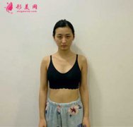 分享我去广州曙光整形美容医院做假体隆胸手术