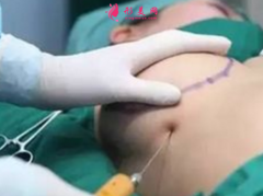 自体脂肪隆胸需要拆线吗？