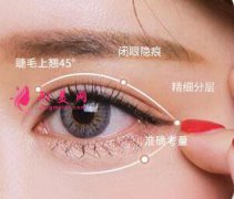 埋线双眼皮会有风险吗？