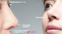 自体软骨隆鼻的恢复期长吗？