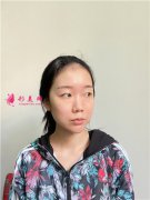 苏州美贝尔美容医院小姐姐全切双眼皮术后效果对比