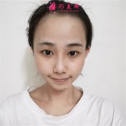 武汉艺星医疗美容医院小仙女眼部综合术后恢复情况分享