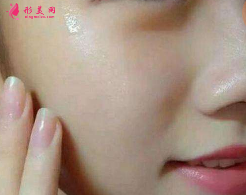 黄金超皮秒祛斑怎么样