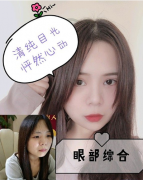 郑州缔莱美怎么样？双眼皮案例，彻底解决肿泡眼