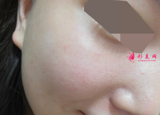 超光子嫩肤祛红血丝要做多少次