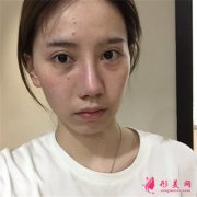 杭州华山连天美膨体隆鼻术后案例分享