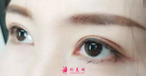 双眼皮手术方法有哪几种呢