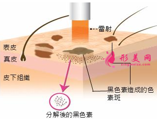 激光祛斑大概需要做几次