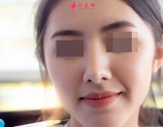 自体脂肪填充脸部费用大约是多少？
