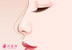 自体软骨隆鼻什么时候拆线？