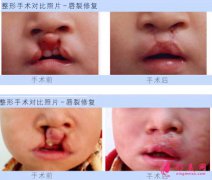 兔唇的最佳治疗时间是多少岁?