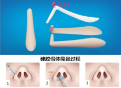 假体隆鼻松动了要取出来吗?