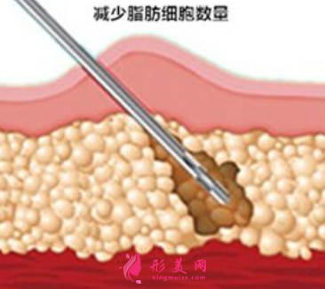 吸脂瘦身要多少钱