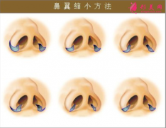 缩鼻翼手术多少钱？