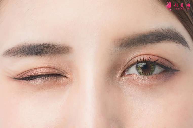 双眼皮手术哪个年龄段做比较适合