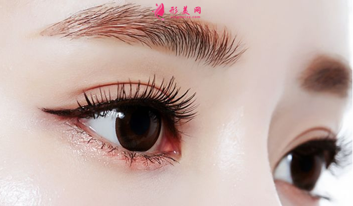 埋线双眼皮术后怎么护理