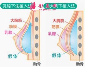 假体隆胸术适合哪些人群