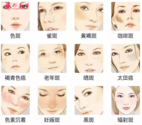 脸上有色斑怎么治疗好？