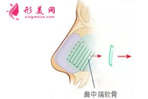 鼻中隔软骨