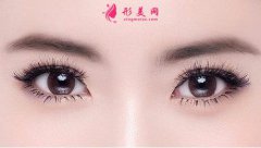 全切双眼皮和埋线双眼皮哪个效果更好?埋线双眼皮好不好?