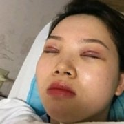 天津公安医院双眼皮怎么样？哪些人不能做双眼皮手术？