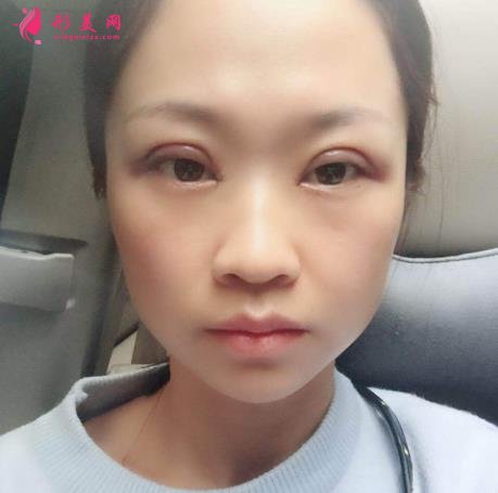 深圳北大医院整形科做双眼皮怎么样？案例及价格表（多少钱）在线参考