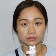 深圳北大医院整形科做双眼皮怎么样？案例及价格表（多少钱）在线