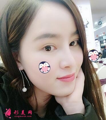 重庆市中山医院整形美容科价格表，附隆鼻案例效果对比图