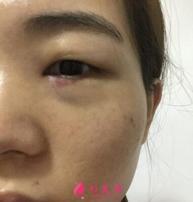 浙江省中医院整形科去眼袋怎么样?价格表|简介|案例效果多图反馈