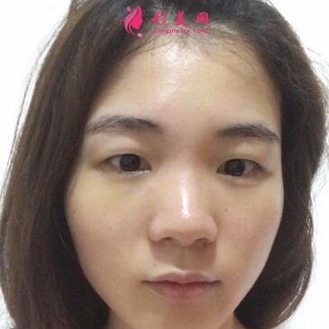 浙江省中医院整形科去眼袋怎么样?价格表|简介|案例效果多图反馈