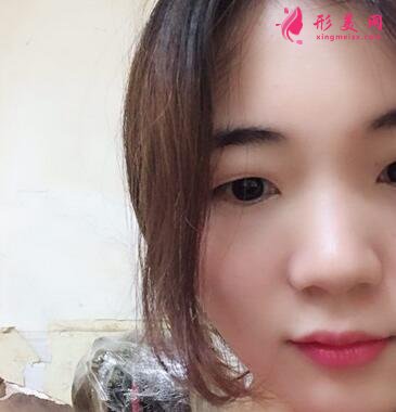 浙江省中医院整形科去眼袋怎么样?价格表|简介|案例效果多图反馈