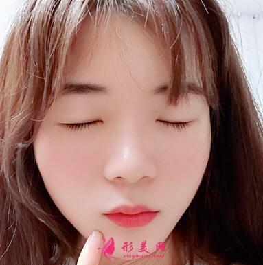 浙江省中医院整形科去眼袋怎么样?价格表|简介|案例效果多图反馈