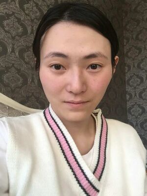 太原美之妍全脸脂肪填充+自体脂肪丰胸恢复效果图