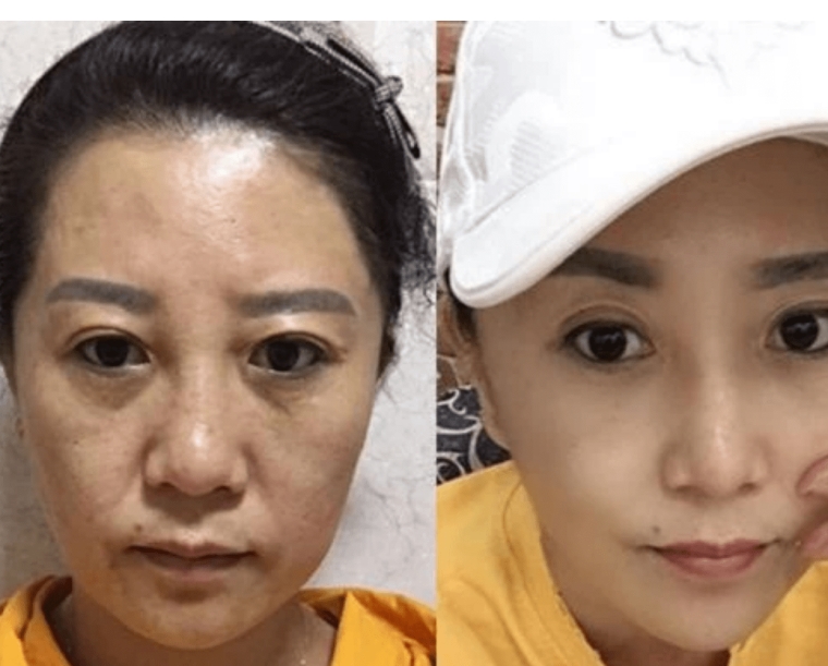 过来人聊聊天津做鼻翼缩小手术多少钱