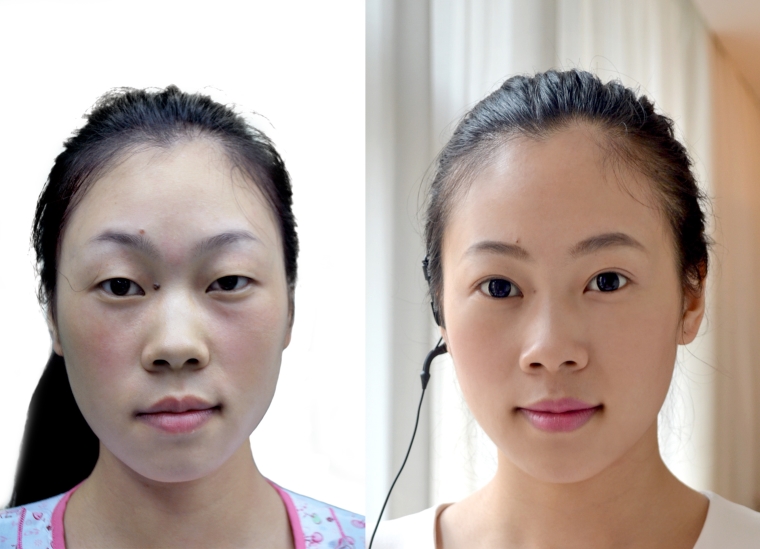 编辑来谈谈福州上眼提肌手术多少钱