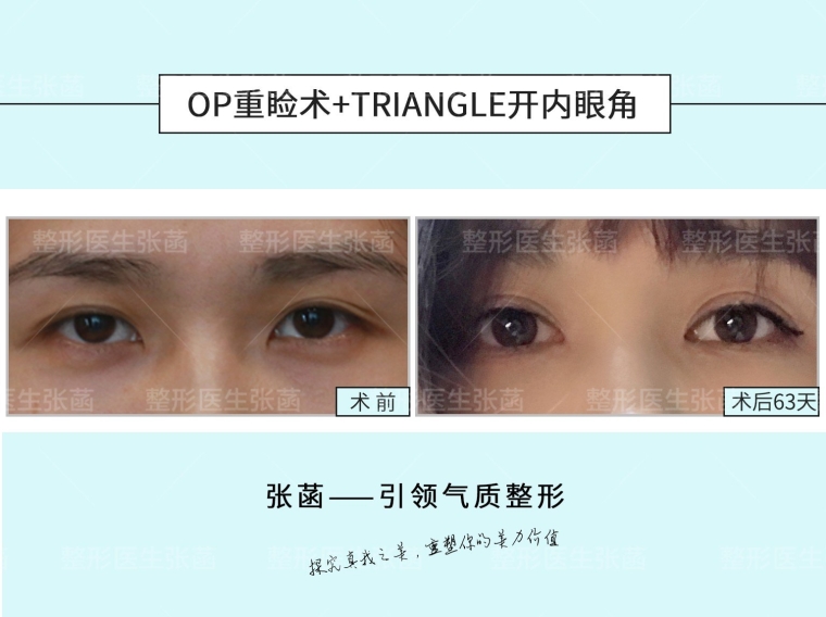 图文解答杭州埋线双眼皮价格多少