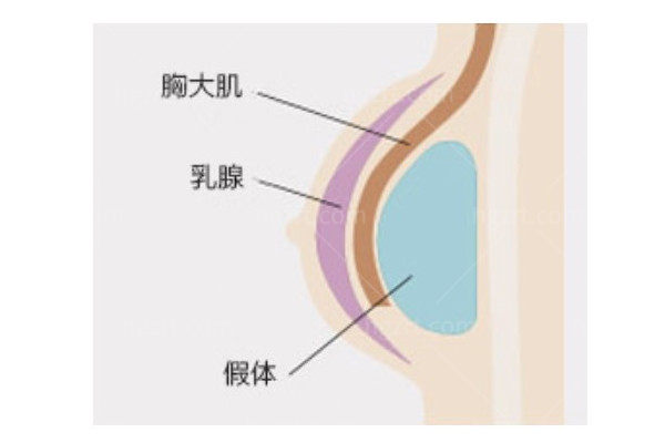 800cc假体隆胸前后对比，前后差别真的好大，隆胸使我自信满满