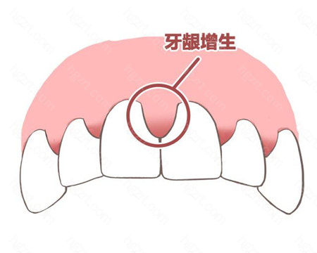牙龈增生是什么原因引起的？症状有哪些