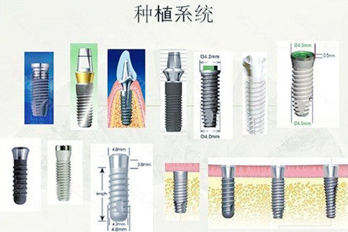 韩国登腾种植牙是纯钛的吗？质量怎么样？和奥齿泰哪个好？