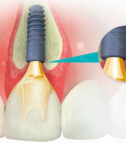 湖州种植牙哪家医院好？来看这份湖州市口腔科医院排名吧！