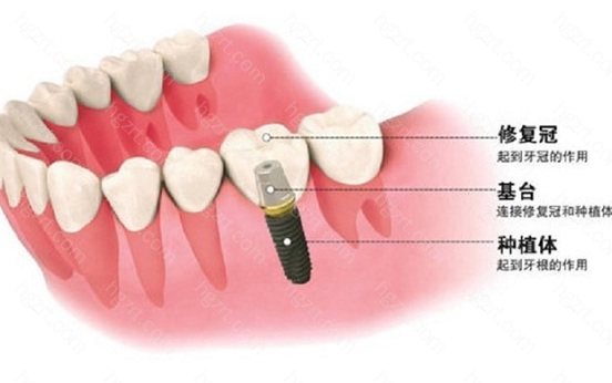茂名种植牙医院哪个好？这几家种牙靠谱的牙科你了解吗？