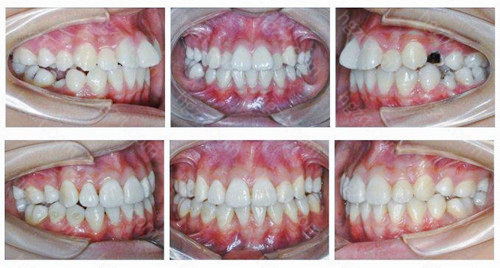 正畸拔牙4颗有危险吗？来看牙齿矫正拔牙利与弊详细分析！