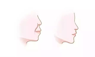 牙齿矫正后容貌变化，真的会变好看吗？