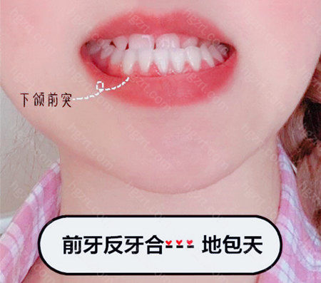 地包天牙齿矫正的适宜年龄是多少？矫正价格很贵吗