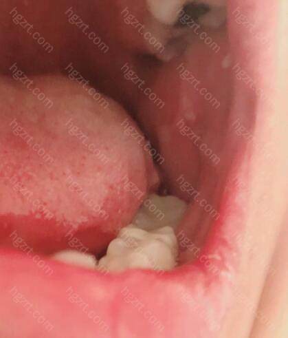 26岁做了种植牙我好后悔！植牙骨粉那一步太痛苦了！