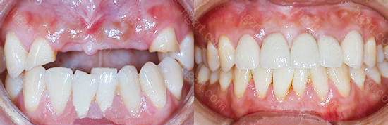 即刻种植牙好还是3月后种植好？从牙槽骨条件帮你分析清楚！