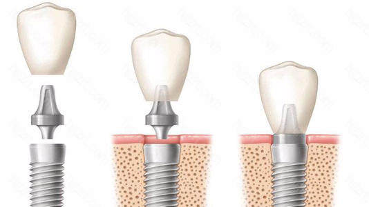 韩国种植牙登腾和奥齿泰哪个好？从优势价格对比看清两者有啥区别