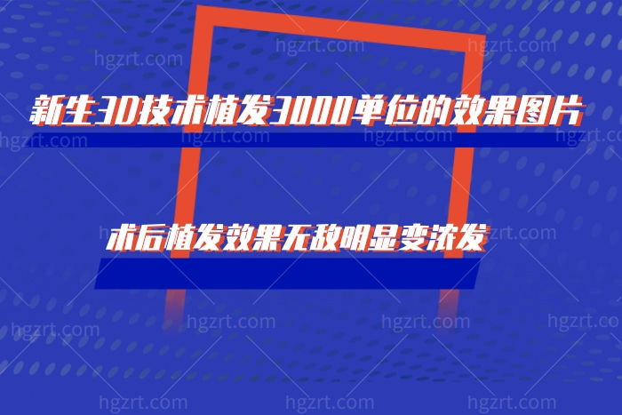 新生3D技术植发3000单位的效果图片，术后植发效果无敌明显变浓发