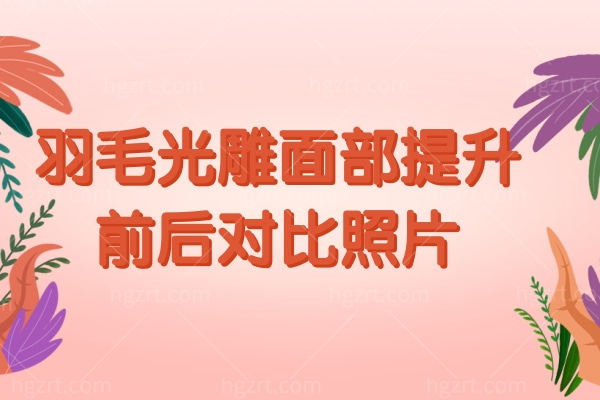 羽毛光雕面部提升前后对比照片,能够维持多长时间多少钱
