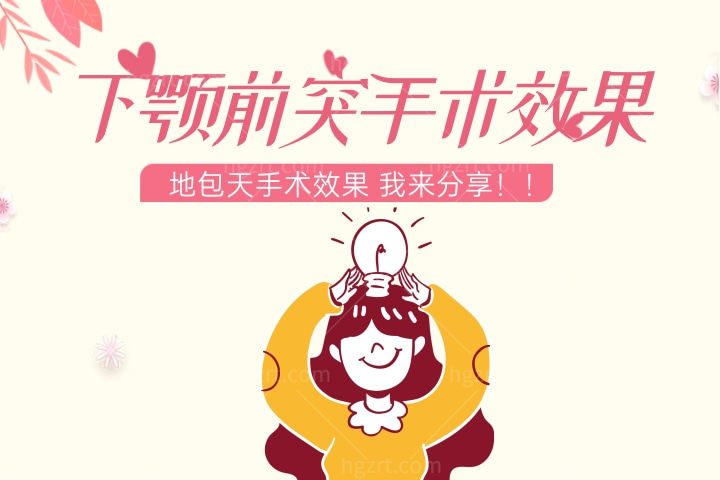 下颚前突/地包天的手术效果改变了我之前的样子